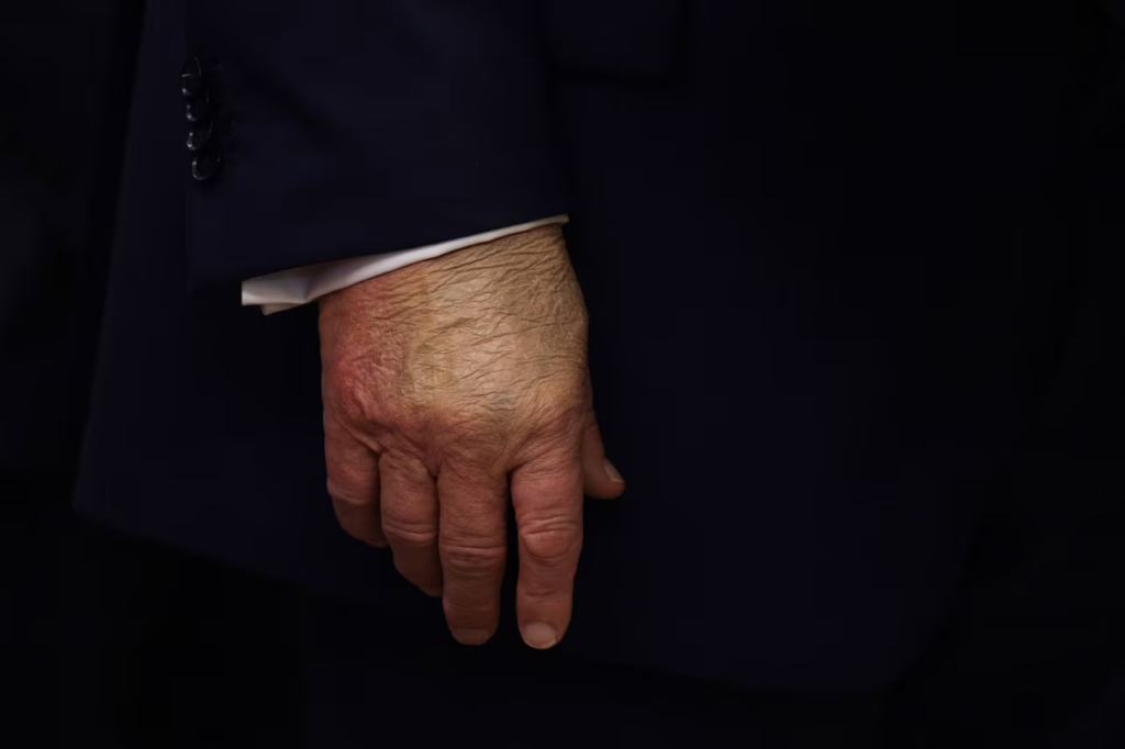 A detailed view of President Donald Trump's hand as he speaks in the Oval Office on Tuesday. Alex Wong/Getty Images