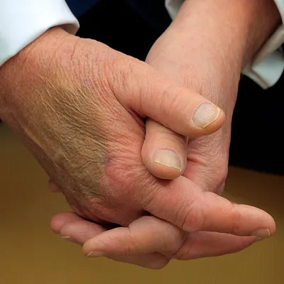 the president's brusied hands covered with makeup