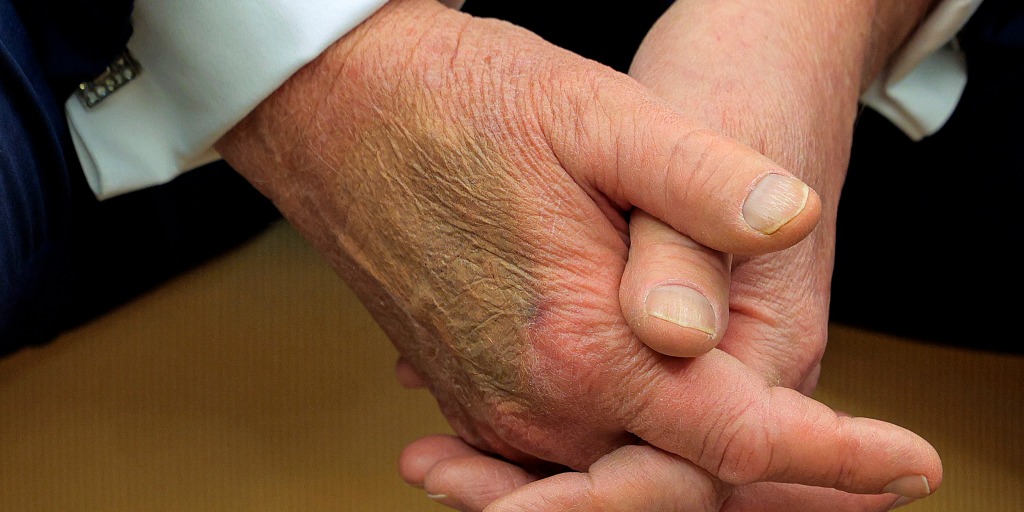 President Donald Trump with bruise on his hand