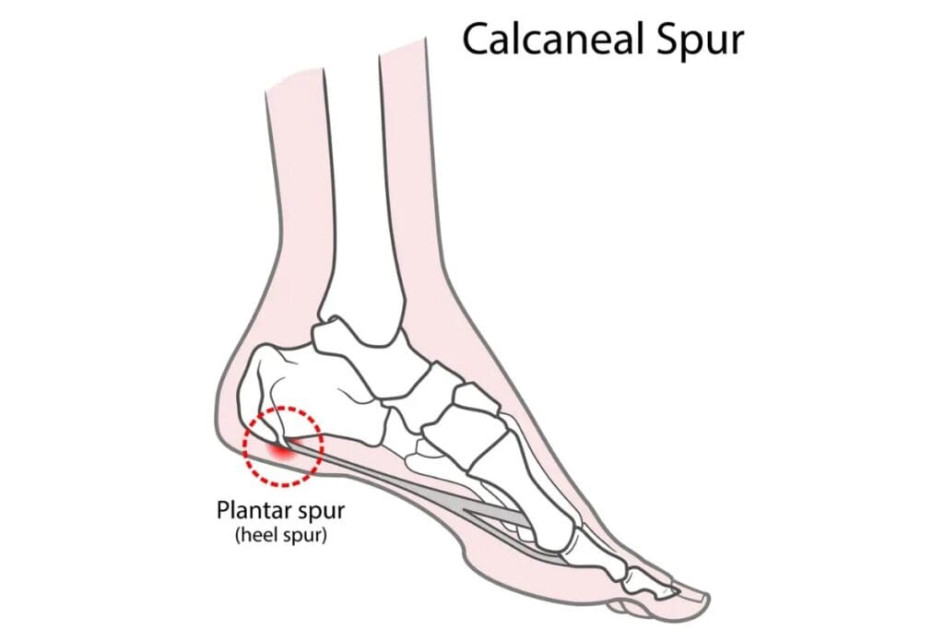 medical diagram showing heel bone spurs illustration